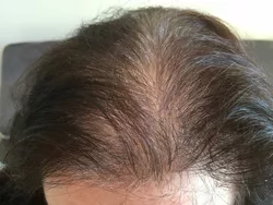 Ce que cette étude signifie pour les personnes souffrant de perte de cheveux